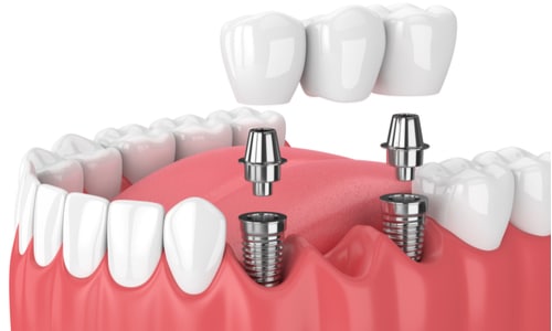 All On 5 Dental Implants