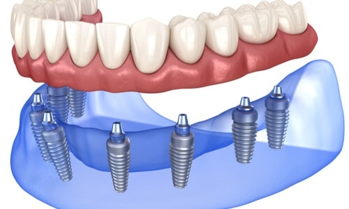 All On 8 Dental Implants
